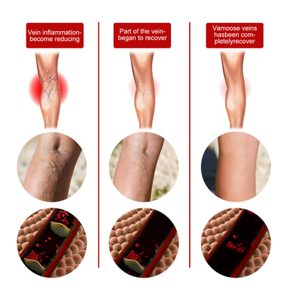 South Moon Herbal Patch for Leg Pain Relief and Care